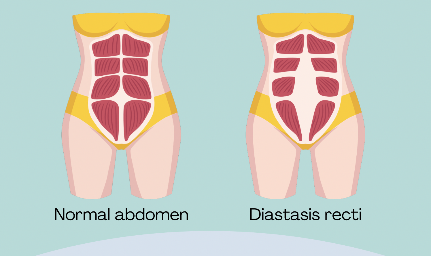 diagram of a normal abdomen versus one with diastasis recti